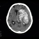 Cerebral hemorrhage, hypertonic hemorrhage, hemocephalus, subfalcine herniation, descendent transtentorial herniation: CT - Computed tomography